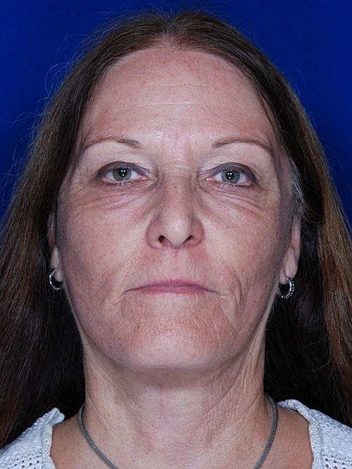 Facelift Before & After