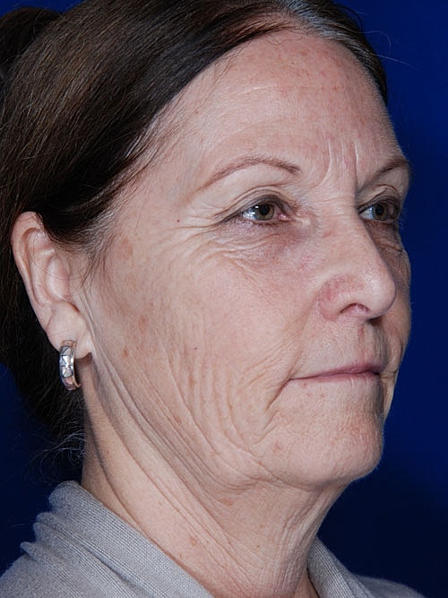 Facelift Before & After