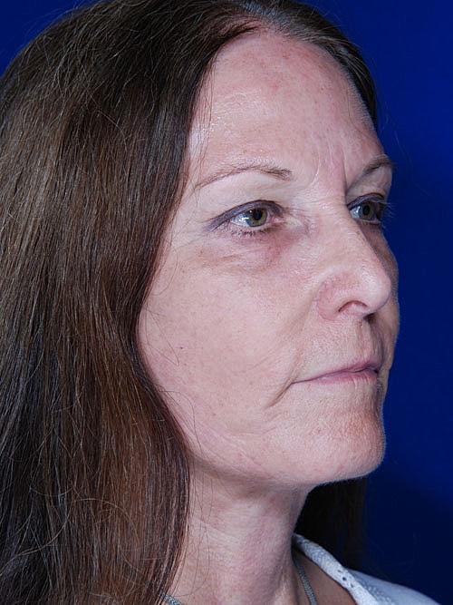 Facelift Before & After