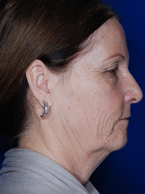 Facelift Before & After