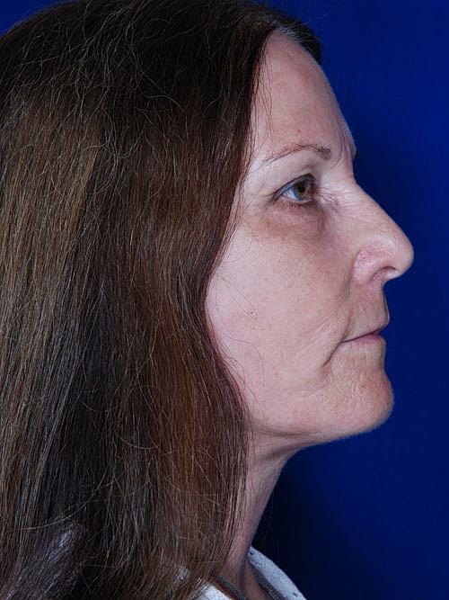 Facelift Before & After