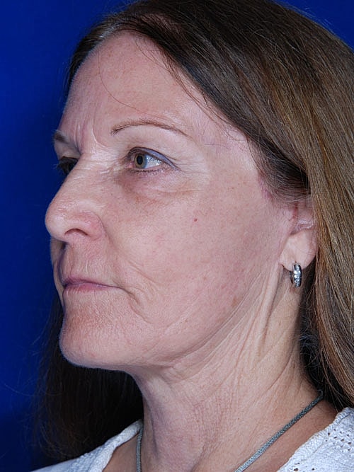Facelift Before & After