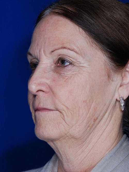 Facelift Before & After