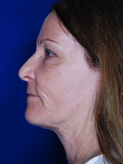 Facelift Before & After