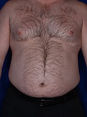 Male Liposuction Before & After