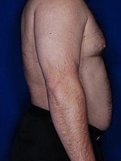 Male Liposuction Before & After