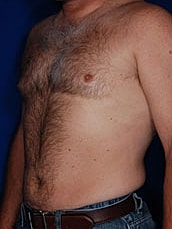 Male Liposuction Before & After