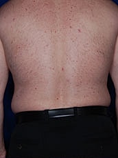 Male Liposuction Before & After