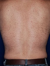 Male Liposuction Before & After