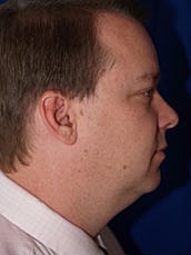 Male Liposuction Before & After