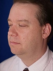 Male Liposuction Before & After