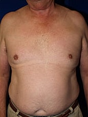 Male Liposuction Before & After