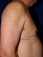 Male Liposuction Before & After
