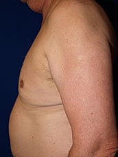 Male Liposuction Before & After
