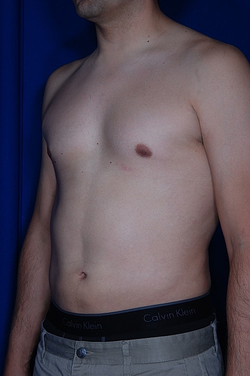 Male Liposuction Before & After