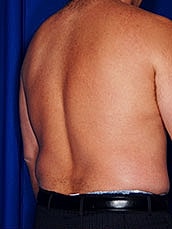 Male Liposuction Before & After