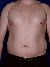 Male Liposuction Before & After