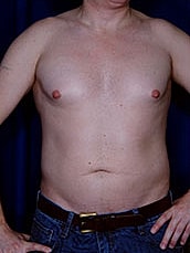 Male Liposuction Before & After