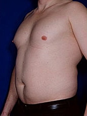 Male Liposuction Before & After