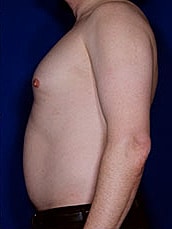 Male Liposuction Before & After