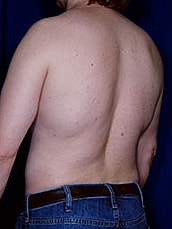 Male Liposuction Before & After