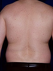 Male Liposuction Before & After