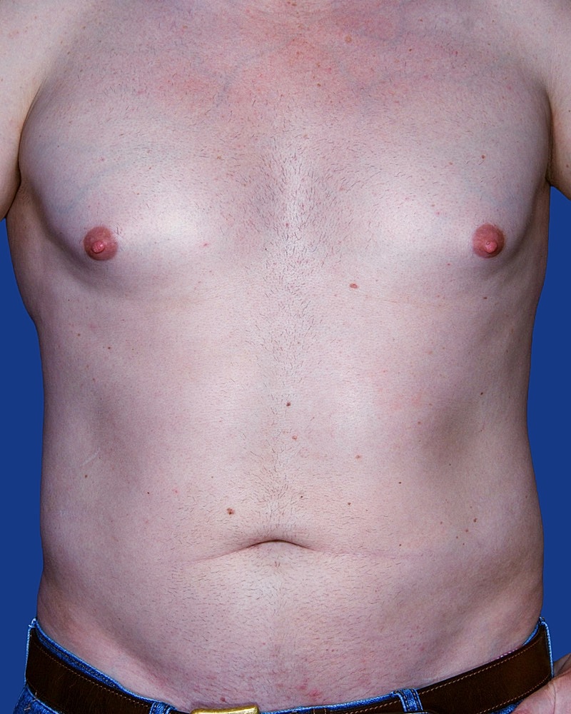 Male Liposuction Before & After