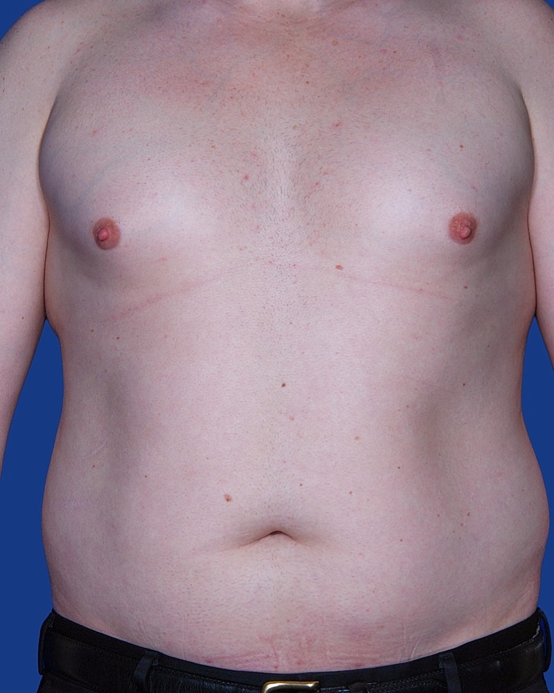 Male Liposuction Before & After