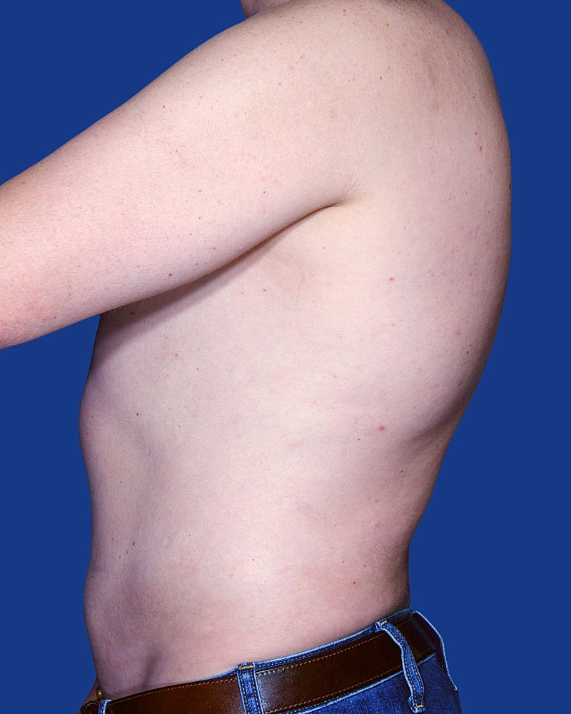 Male Liposuction Before & After