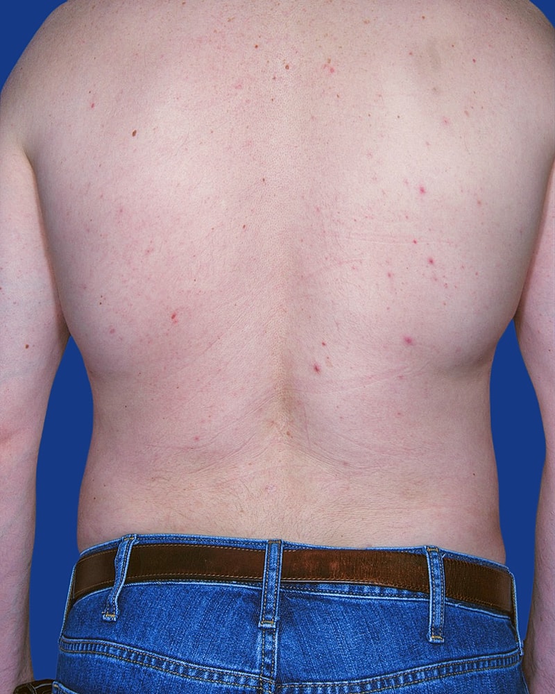 Male Liposuction Before & After