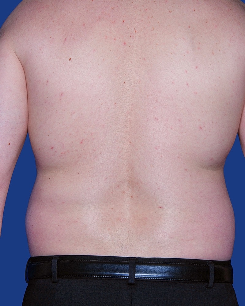 Male Liposuction Before & After
