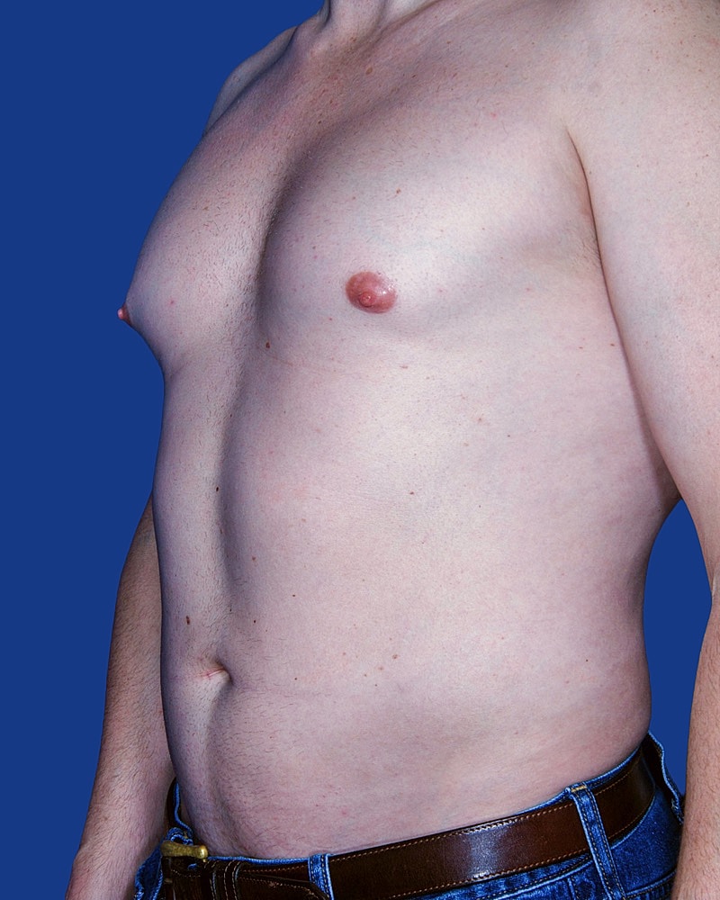 Male Liposuction Before & After