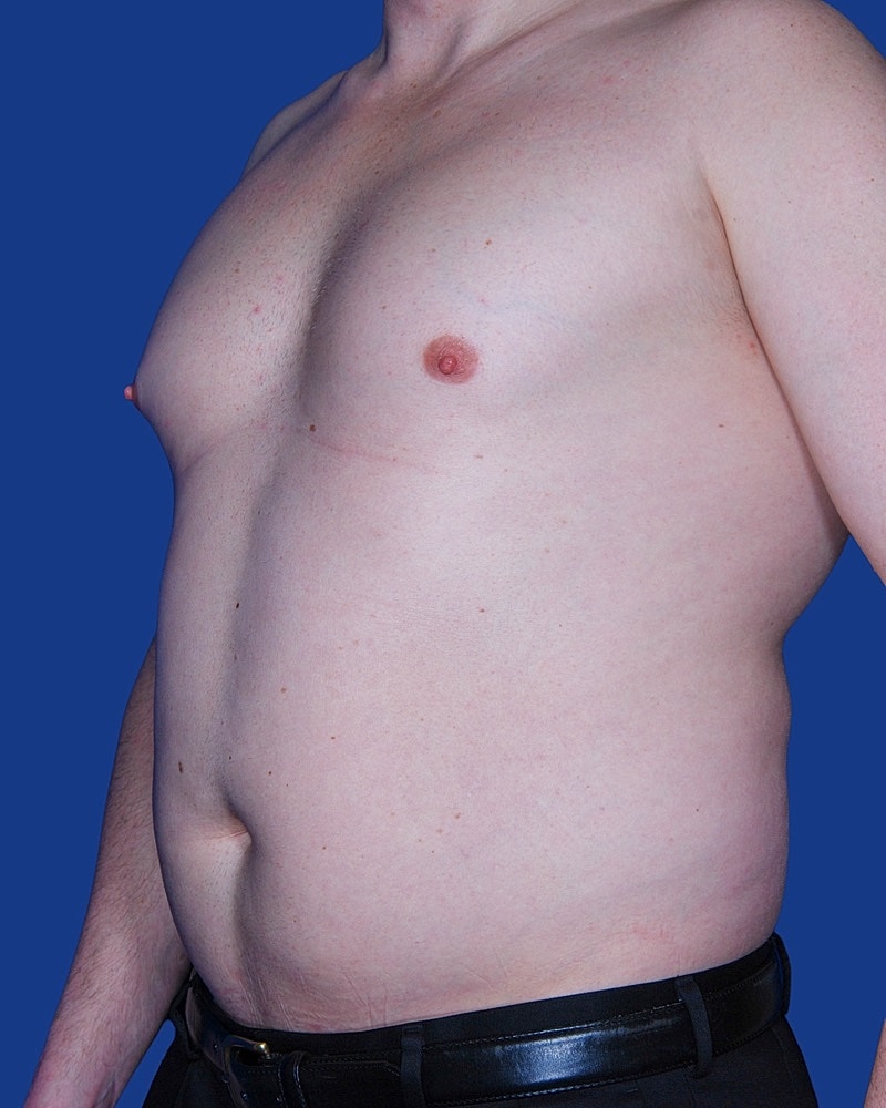 Male Liposuction Before & After