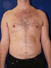 Male Liposuction Before & After