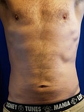 Male Liposuction Before & After