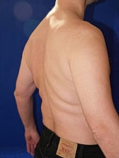 Male Liposuction Before & After