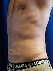 Male Liposuction Before & After