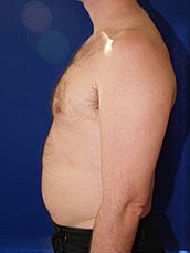 Male Liposuction Before & After