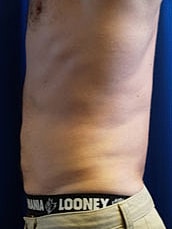 Male Liposuction Before & After