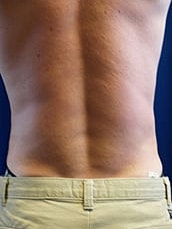 Male Liposuction Before & After