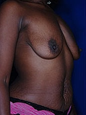 Breast Augmentation With Lift Before & After