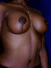 Breast Augmentation With Lift Before & After