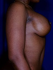 Breast Augmentation With Lift Before & After