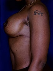 Breast Augmentation With Lift Before & After