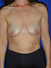 Breast Augmentation With Lift Before & After