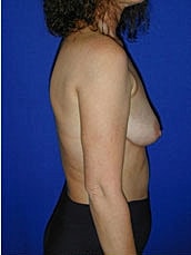 Breast Augmentation With Lift Before & After
