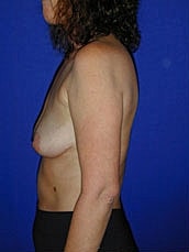 Breast Augmentation With Lift Before & After