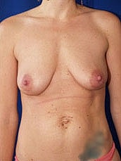 Breast Augmentation With Lift Before & After