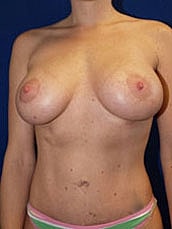 Breast Augmentation With Lift Before & After