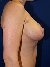 Breast Augmentation With Lift Before & After